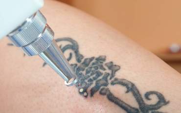 Технология удаления некачественного косметического татуажа и тату при помощи Nd:YAG Q-SWITCH лазера и ремувера