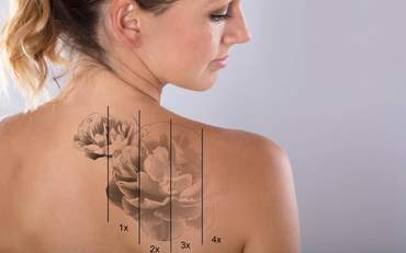 Технология удаления некачественного косметического татуажа и тату при помощи ремувера