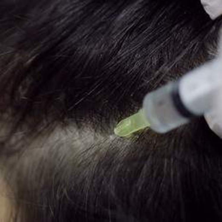 Онлайн-курс Мезотерапия волосистой части головы