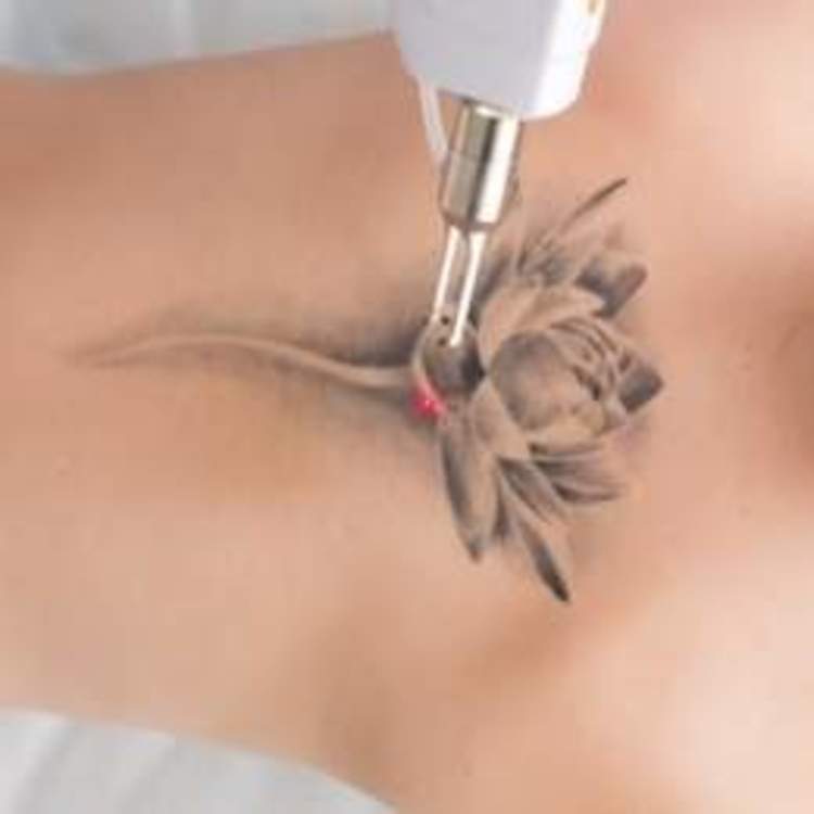 Технология удаления некачественного косметического татуажа и тату при помощи Nd:YAG Q-SWITCH лазера.