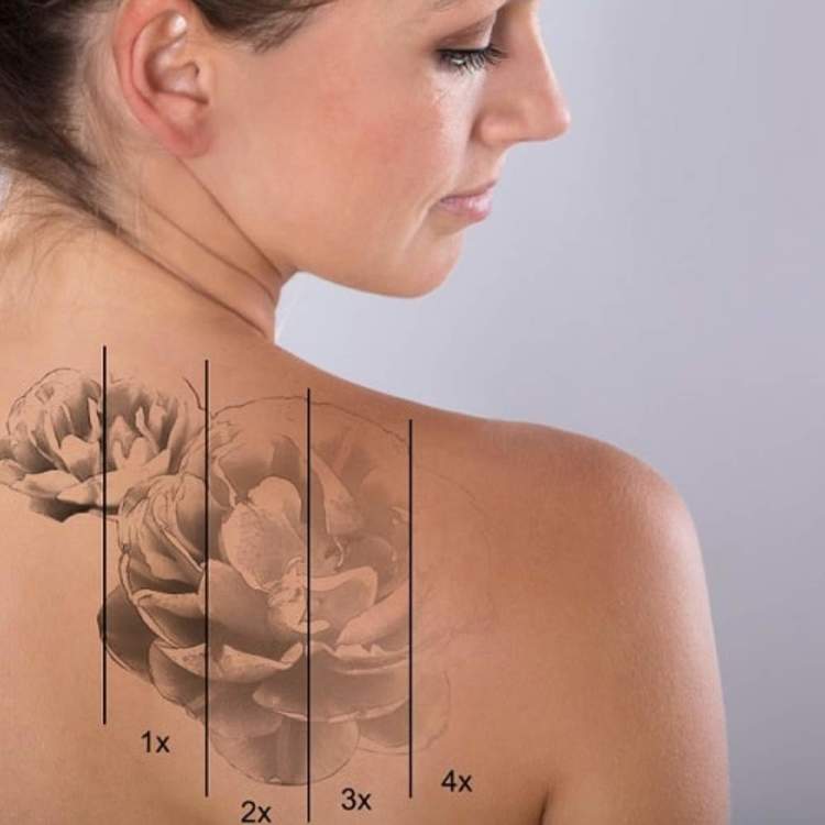 Технология удаления некачественного косметического татуажа и тату при помощи ремувера
